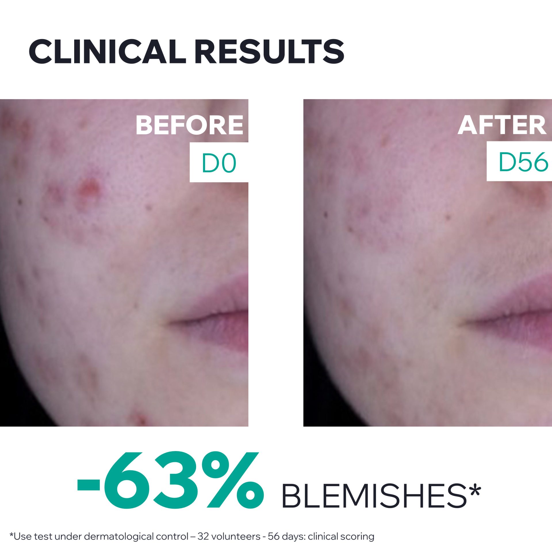 Uriage Hyséac 3-Regul+ Global Anti-Blemish Care 40ml - Image 6