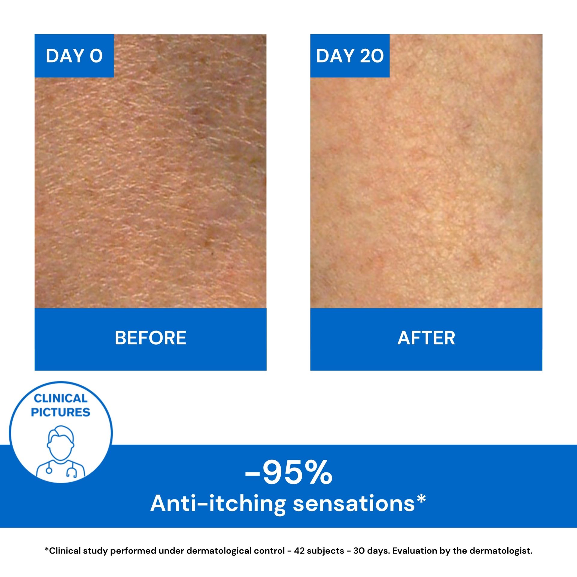 XEMOSE C8+ LIPID REPLENISHING ANTI ITCH CREAM 400ML Before and After